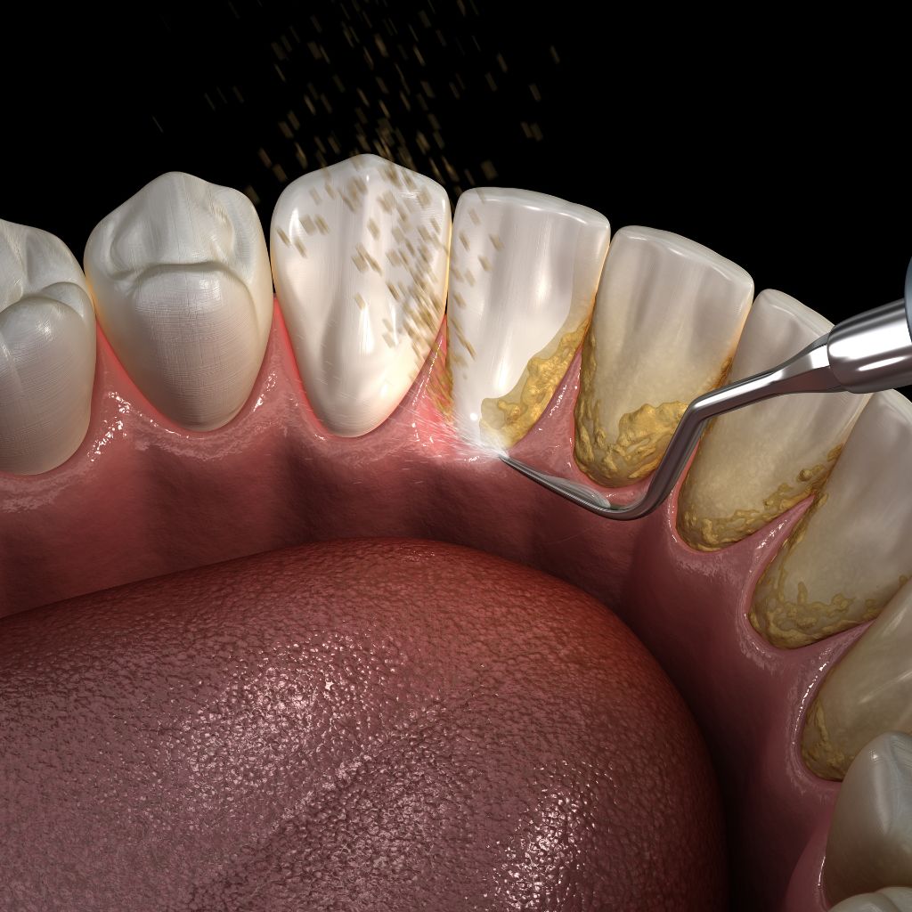 Deep cleaning treatment