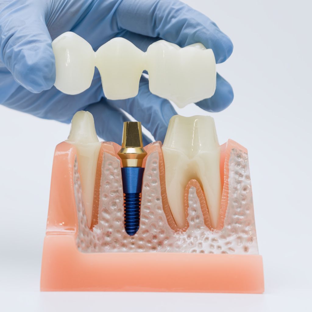 Close-up of a dental crown model on a table