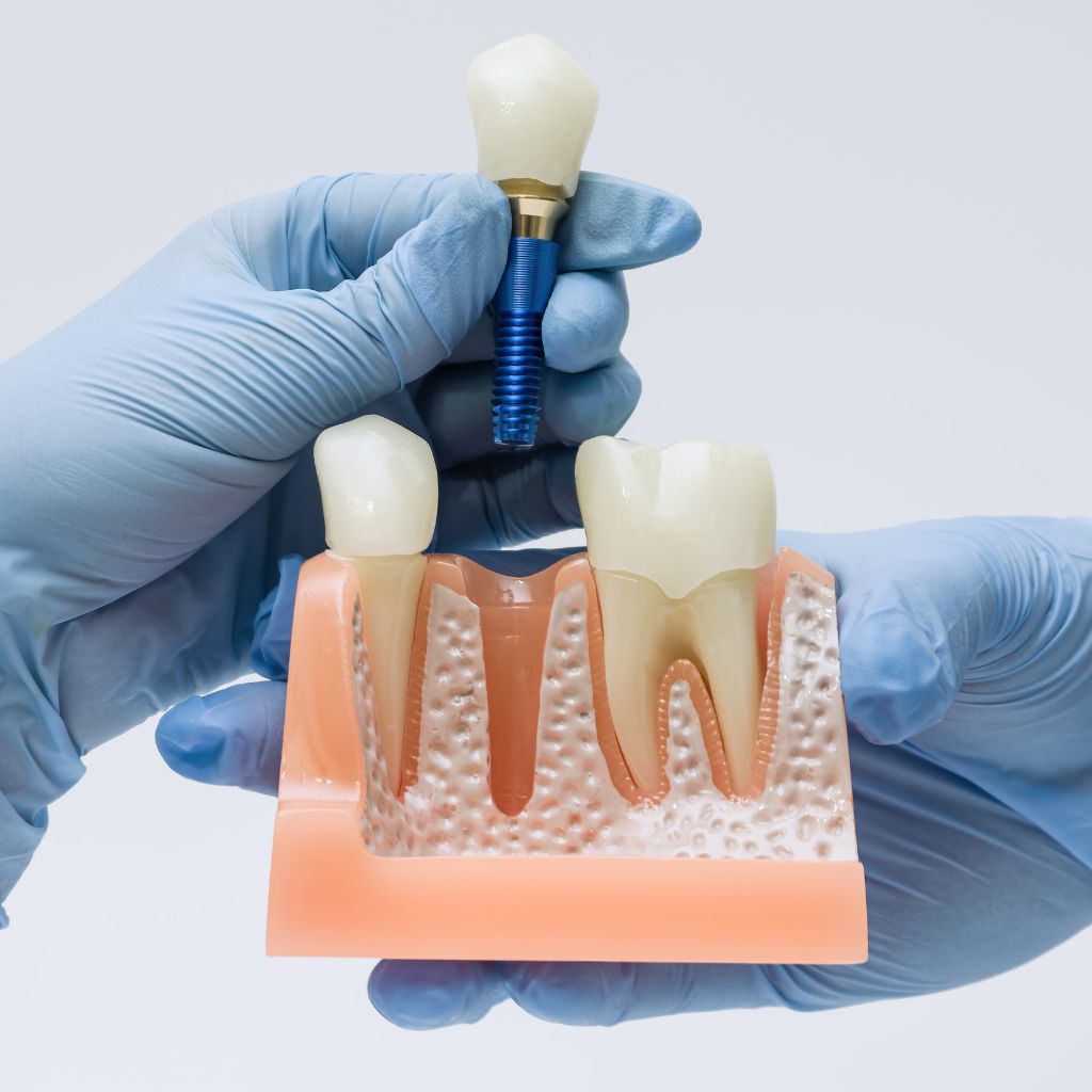 High-tech dental implant models
